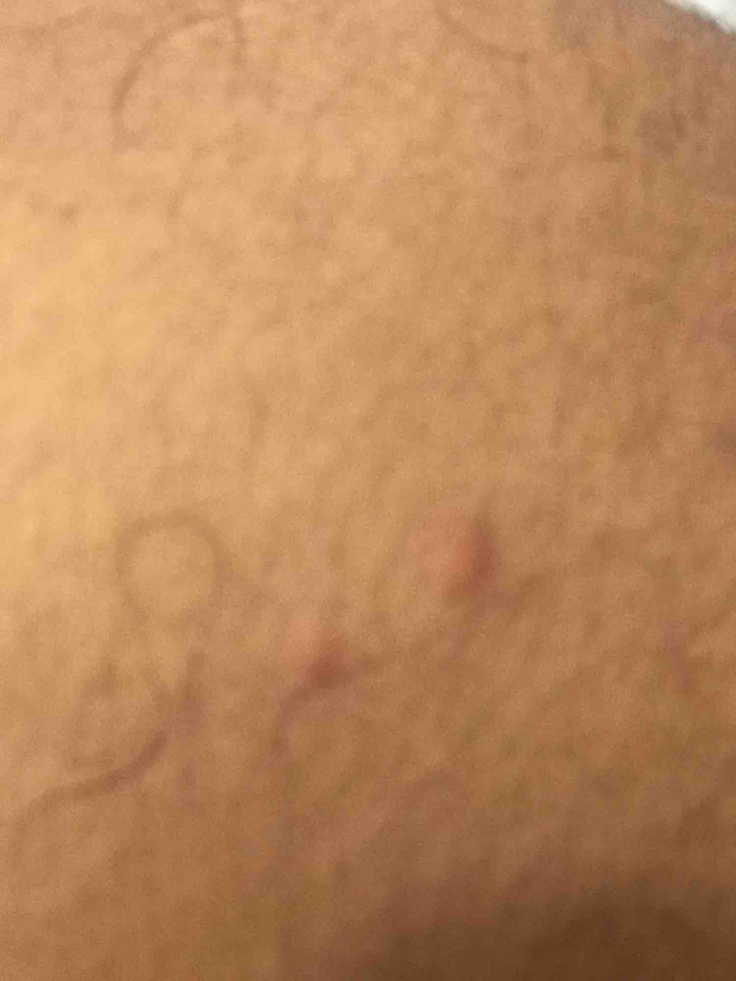 Brauner fleck auf eichel