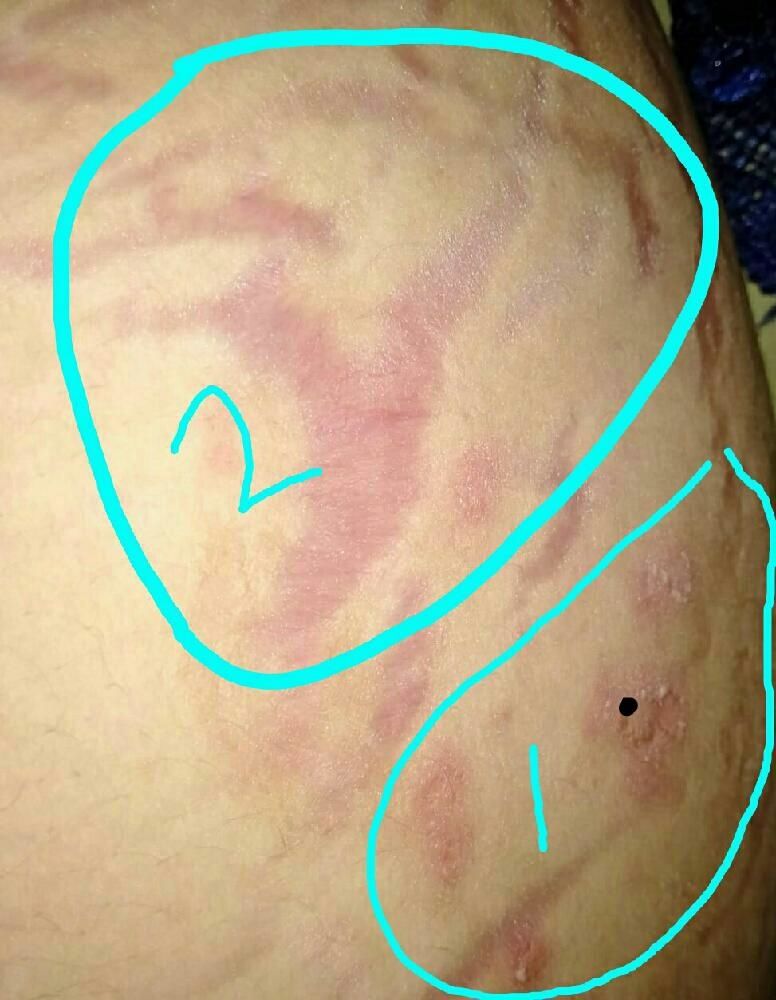 Blue Waffle Disease On A Male The Disease Is Very Uncommon