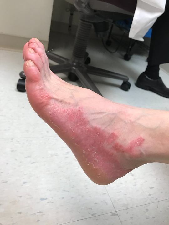 Fungal infection of foot