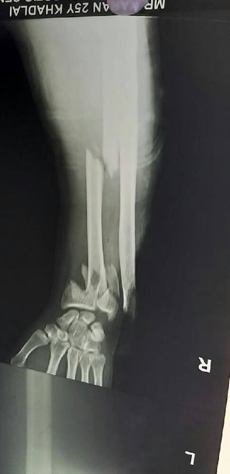 Compound fracture distal radius and ulna Debridement