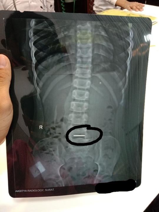Child swallowed coin treatment