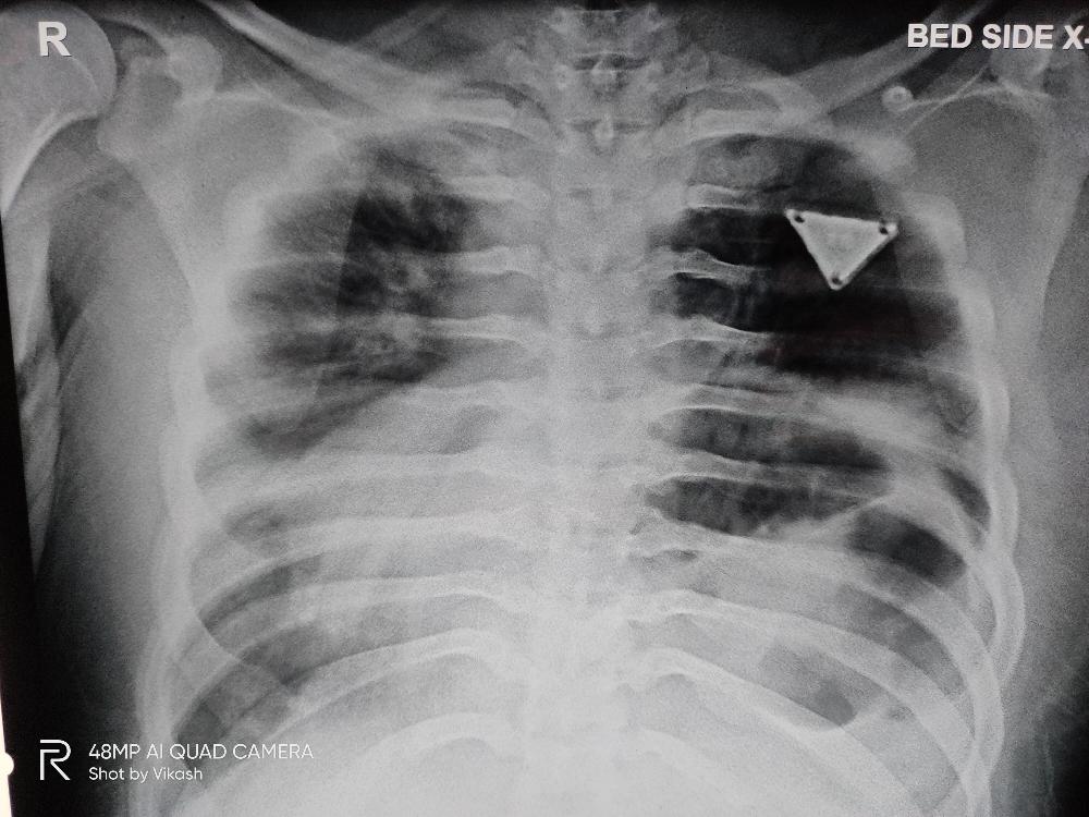 Differential diagnosis of pneumonia