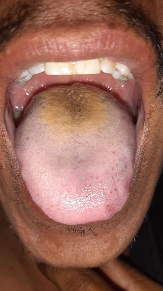 Hyperpigmentation of tongue papillae
