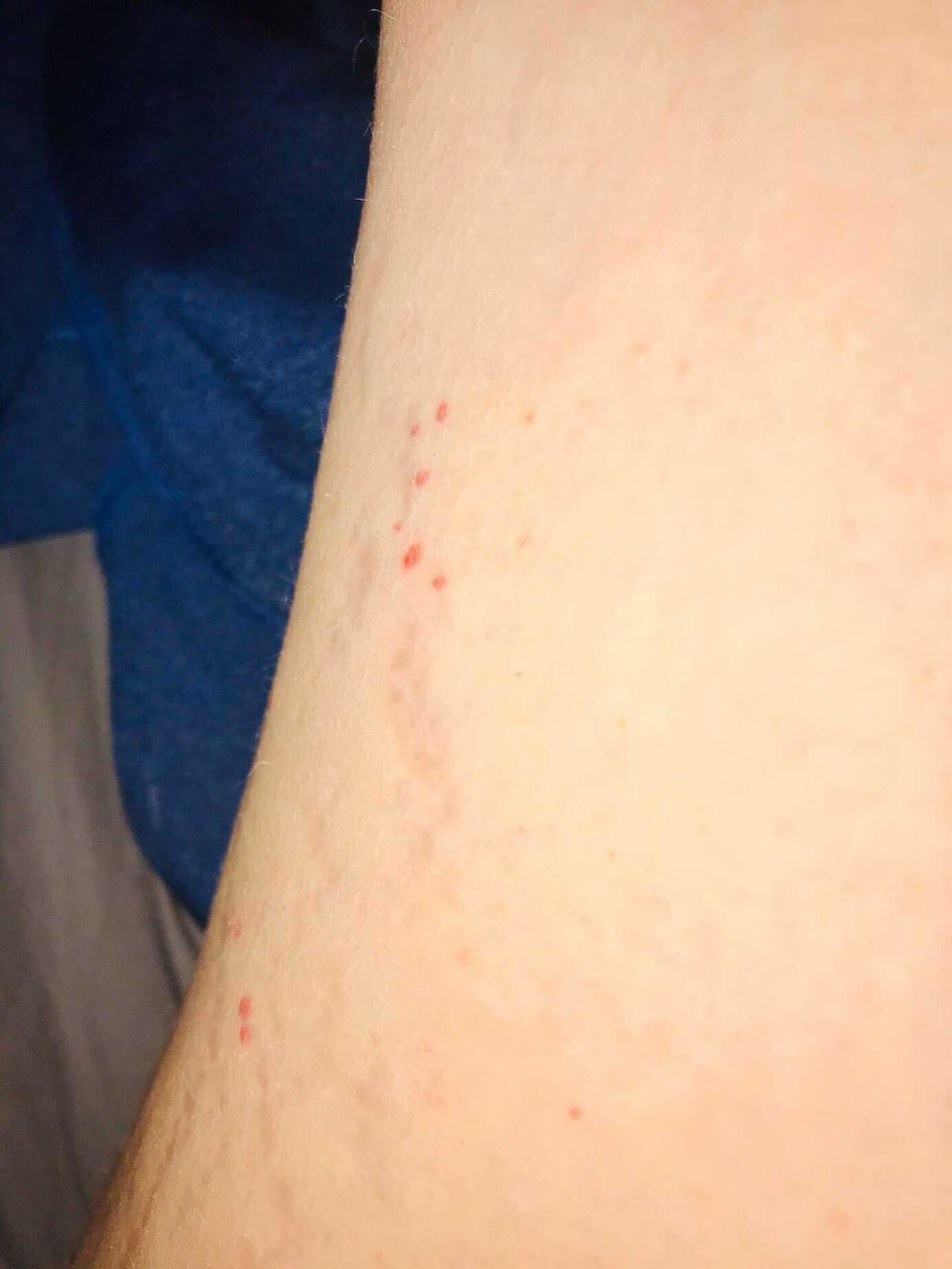 Road rash healing yellow fliplalaf