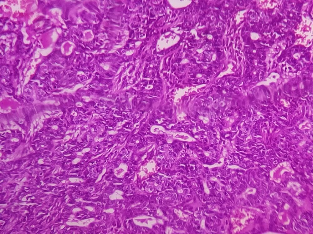 Secretory carcinoma of Parotid gland.