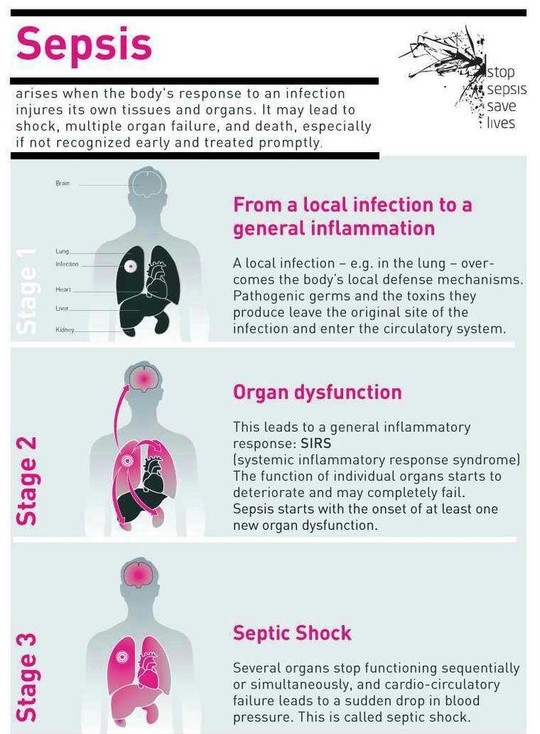 SEPSIS