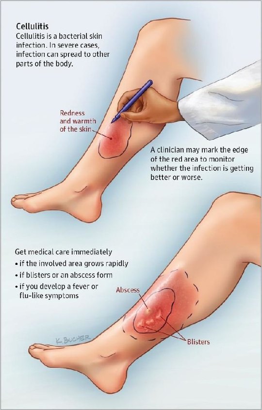 Cellulitis