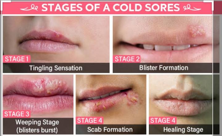 Stages of Cold sores.
