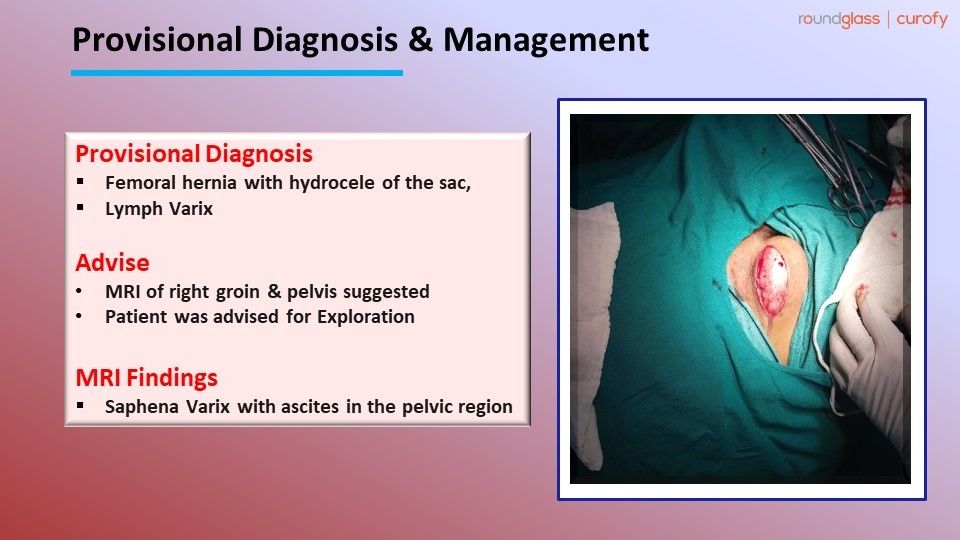 Hydrocele Inguinal Hernia