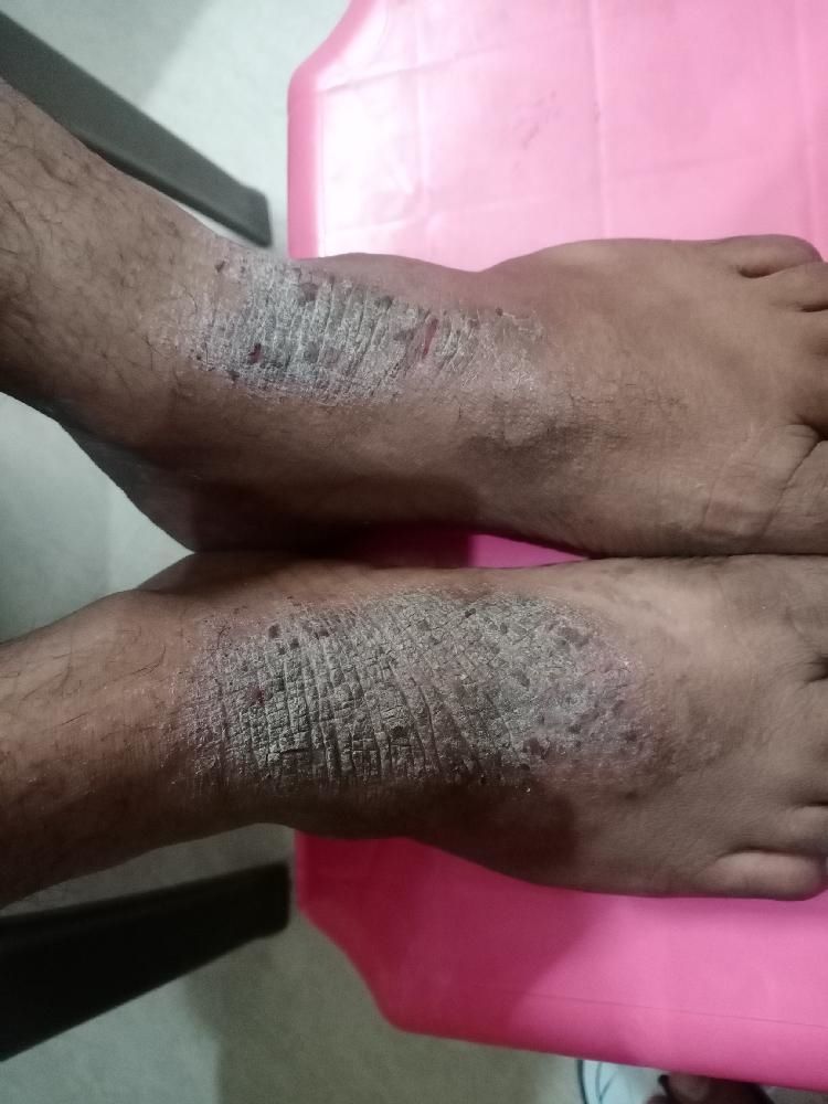 Lichen simplex chronicus/ dry eczema?? Lichen simplex chronicus/ dry eczema??