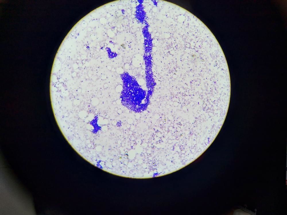 Left Breast Retroareolar Lump, Lactating 30/Female