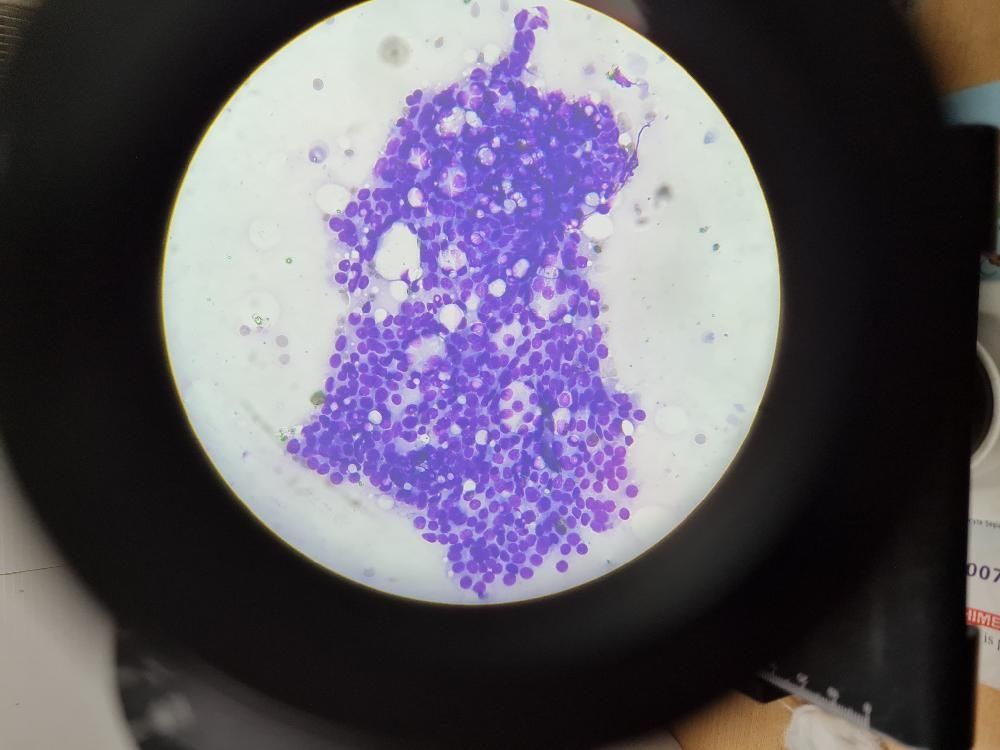 Left Breast Retroareolar Lump, Lactating 30/Female