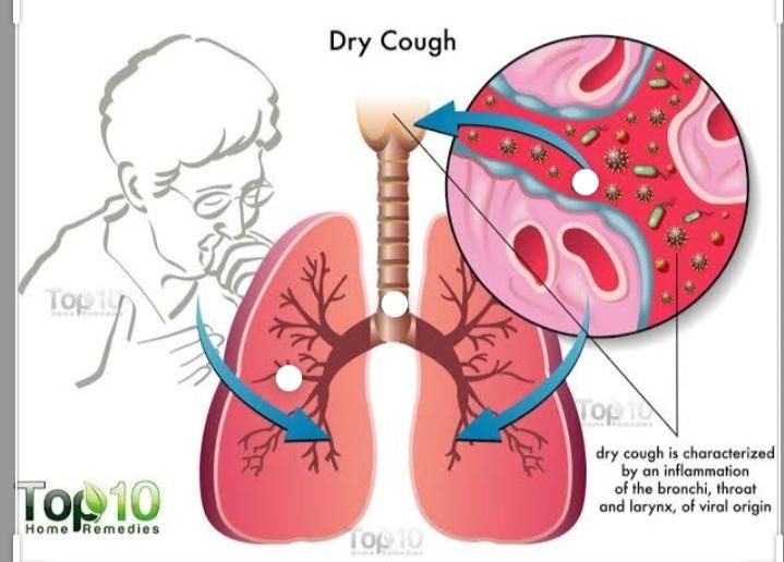 What is Dry cough.