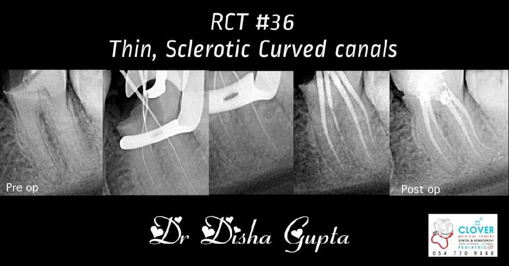 Management of Thin, Calcified, Sclerotic, Curved canals Endodontics