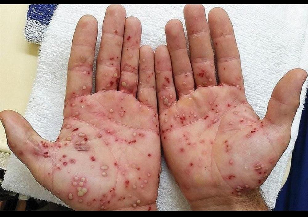 THIS CASE POST STREPTOCOCCAL PUSTULOSIS.