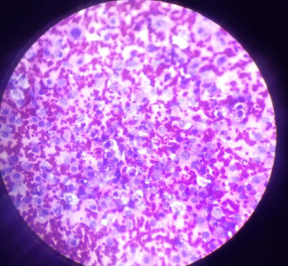 IMPRINT CYTOLOGY OF NIPPLE DISCHARGE