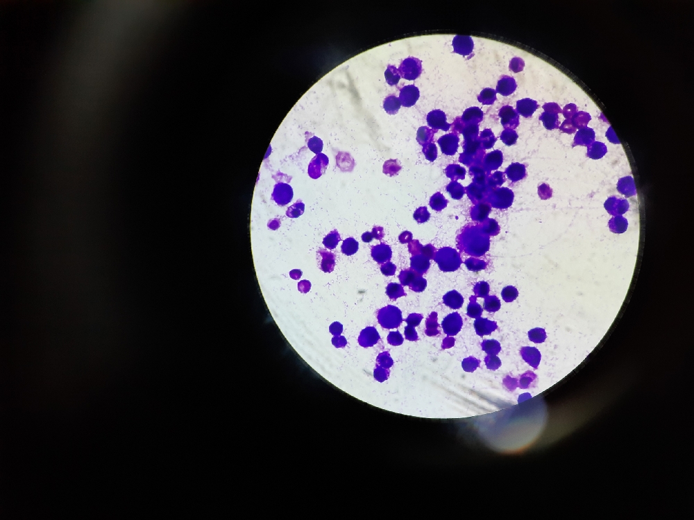 ASCITIC FLUID CYTOLOGY