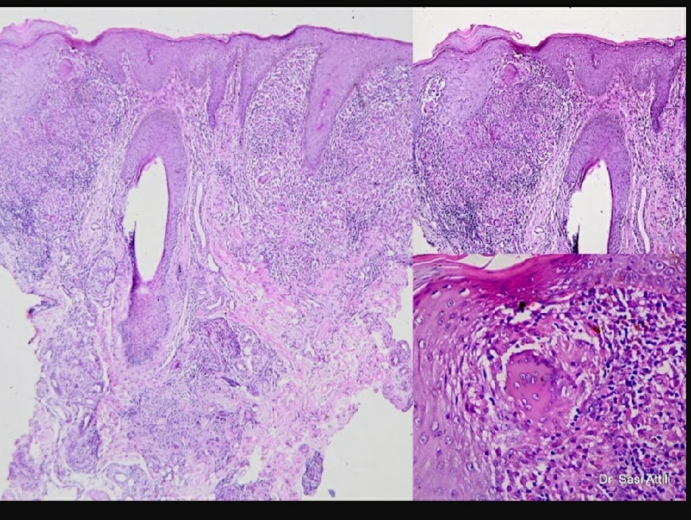LUPUS VULGARIS with PERIORAL DERMATITIS