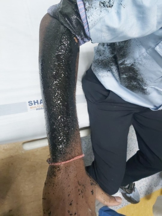 Chemical burns (Tar burns)