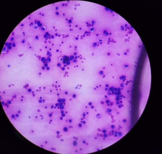 ASCITIC FLUID CYTOLOGY