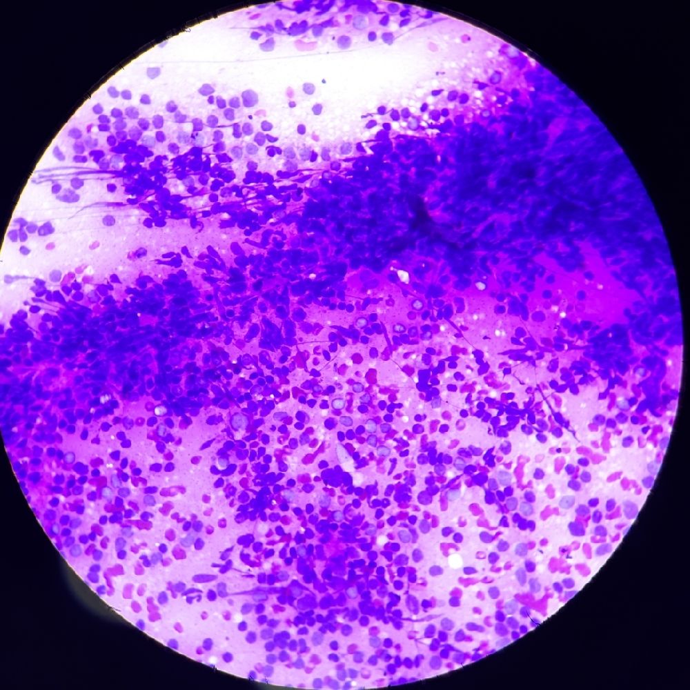 fine-needle-aspiration-cytology
