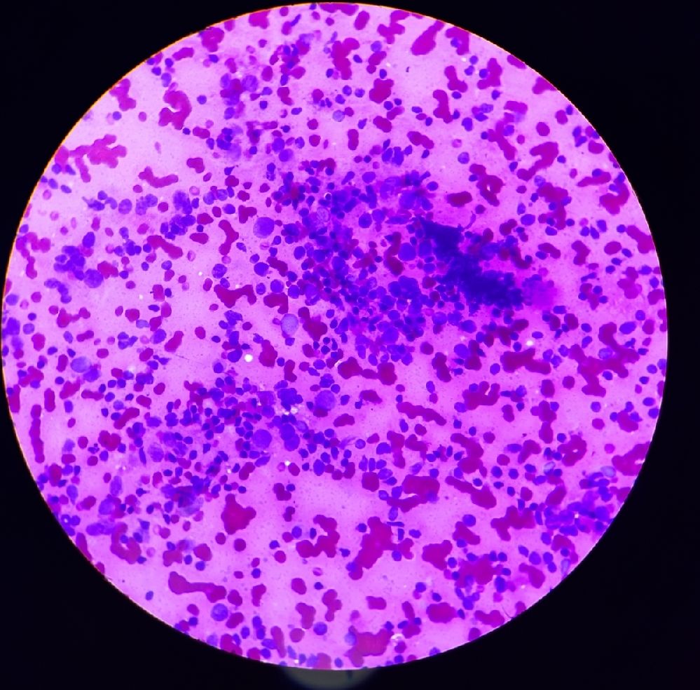 fine-needle-aspiration-cytology