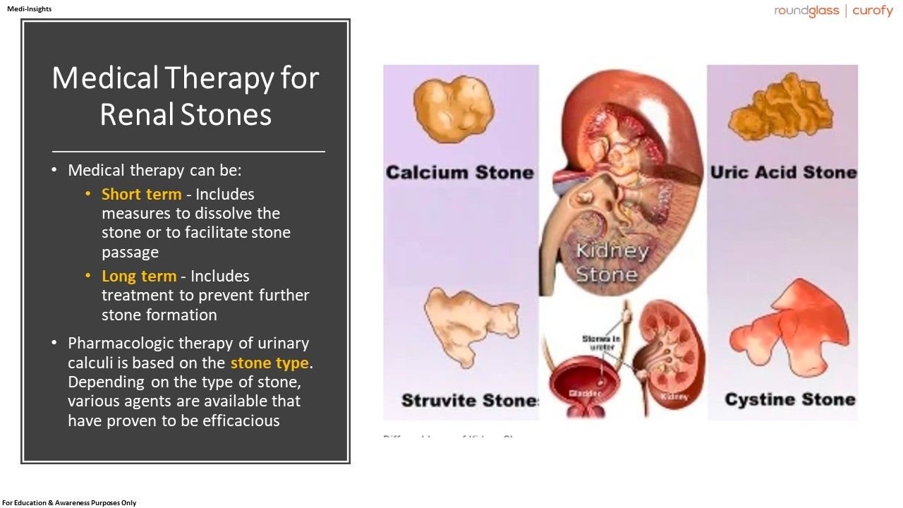 Pharmacologic Management of Kidney Stones AUA Guidelines