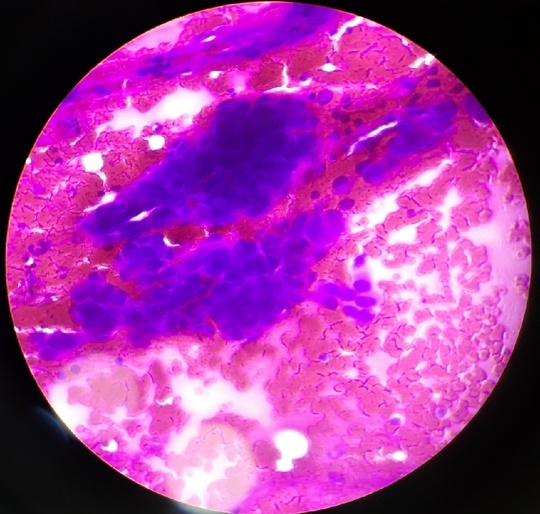 FINE NEEDLE ASPIRATION CYTOLOGY OF BREAST LUMP