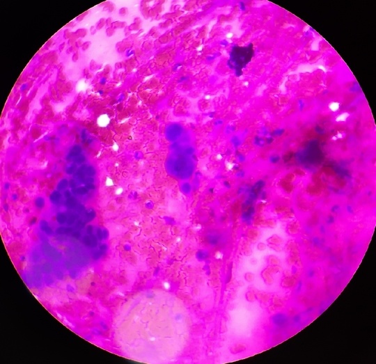 FINE NEEDLE ASPIRATION CYTOLOGY OF BREAST LUMP