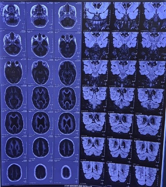 Pachygyria Lissencephaly