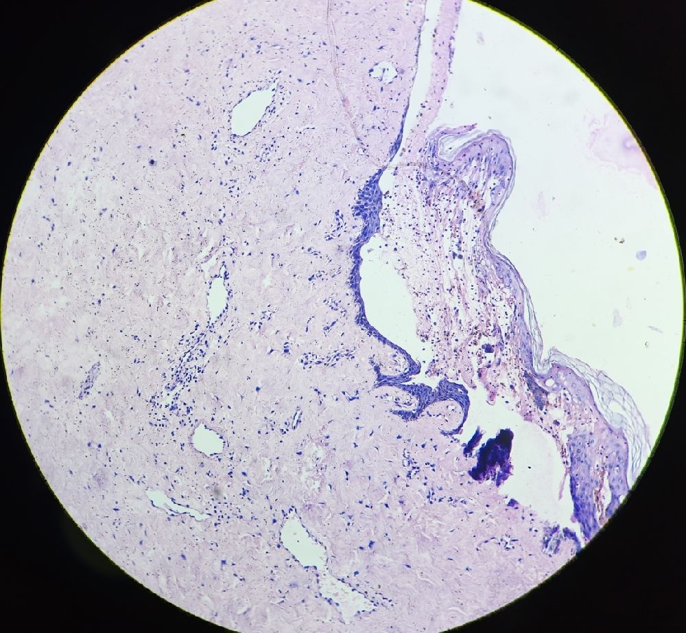 32 y nipple cyst biopsy