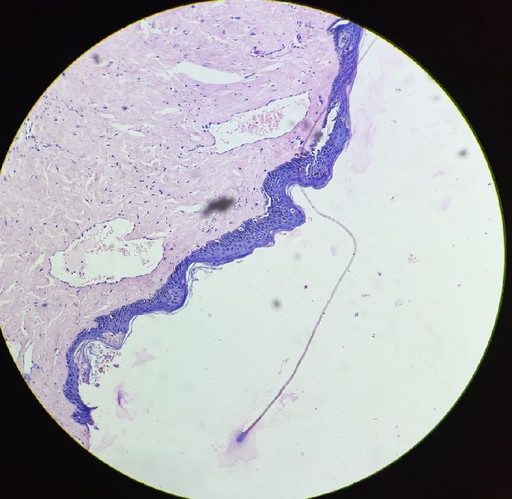 32 y nipple cyst biopsy