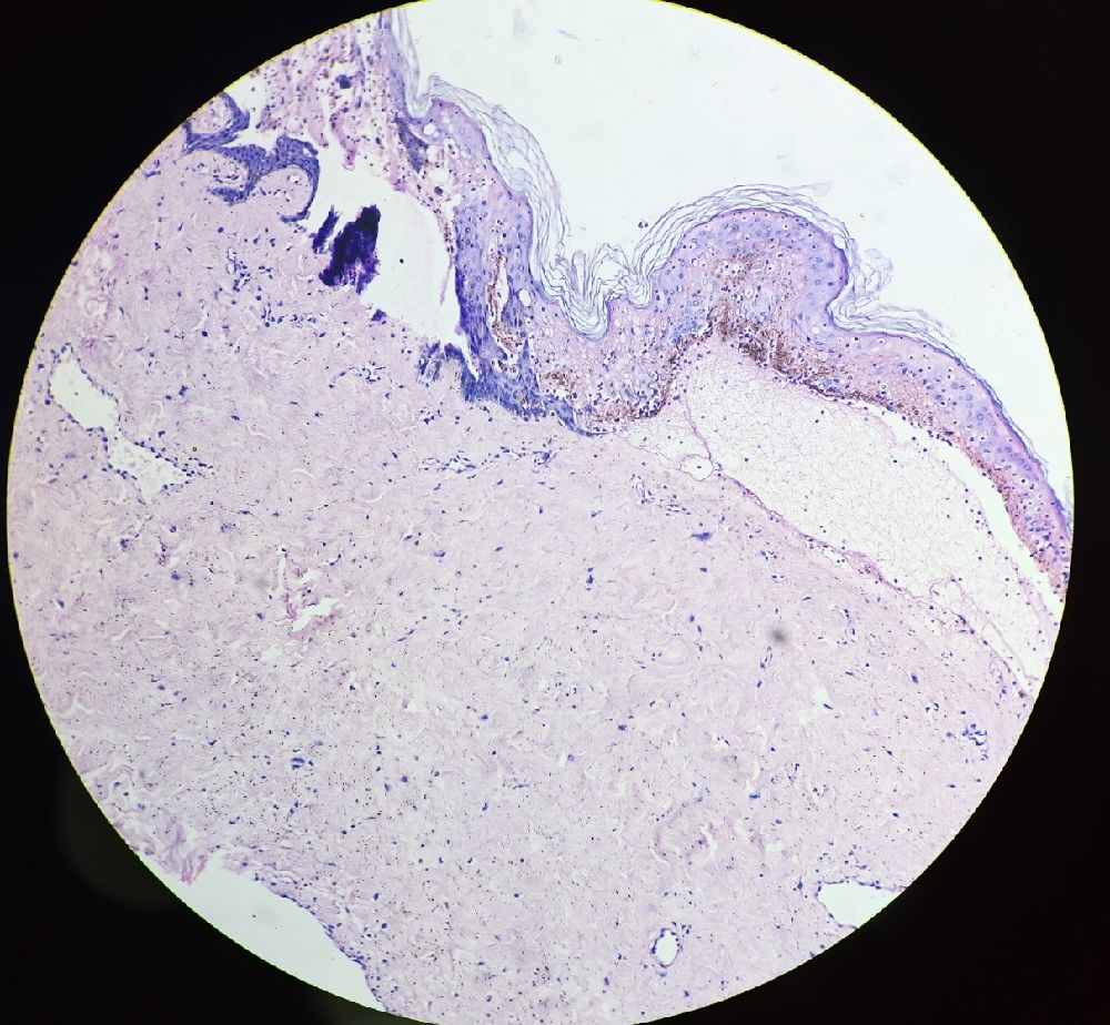 32 y nipple cyst biopsy