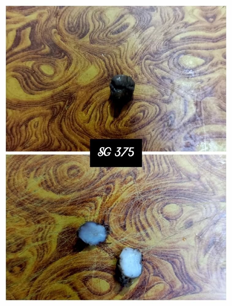 BIOPSY OF NIPPLE CYST