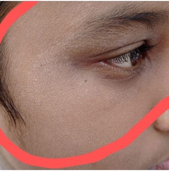 Atopic dermatitis and Ayurveda