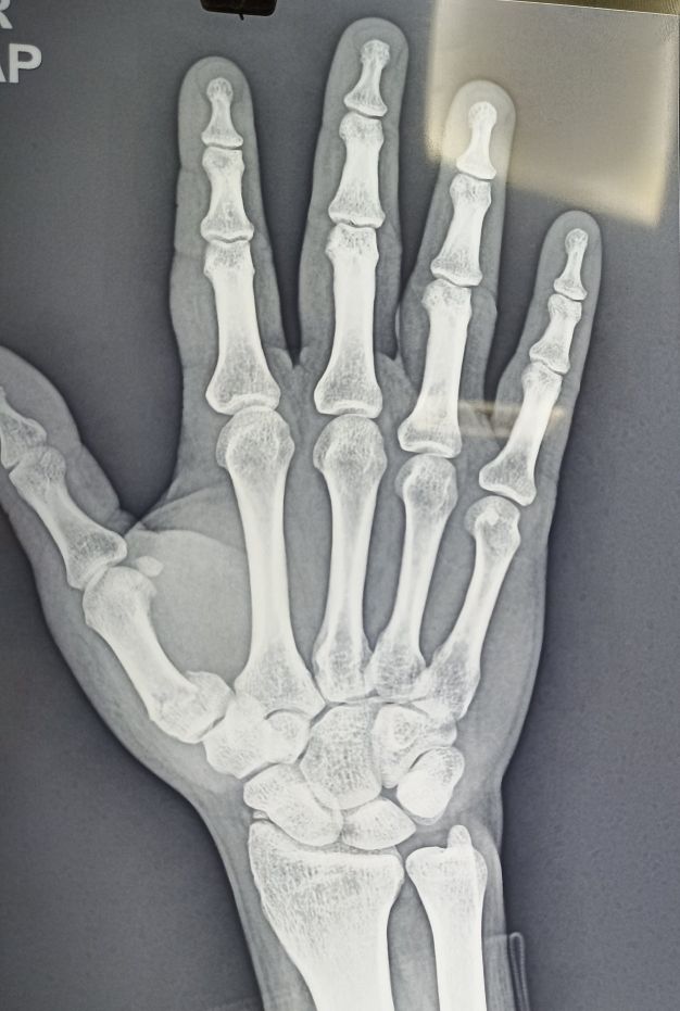 Pls Rx for K wire procedure in right hand's thumb metacarpal