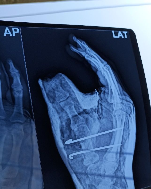 Pls Rx for K wire procedure in right hand's thumb metacarpal
