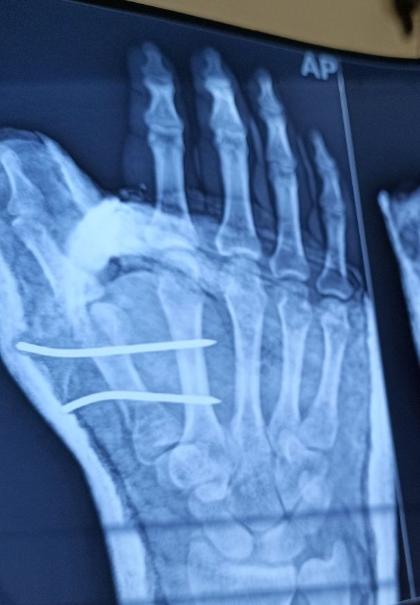 Pls Rx for K wire procedure in right hand's thumb metacarpal