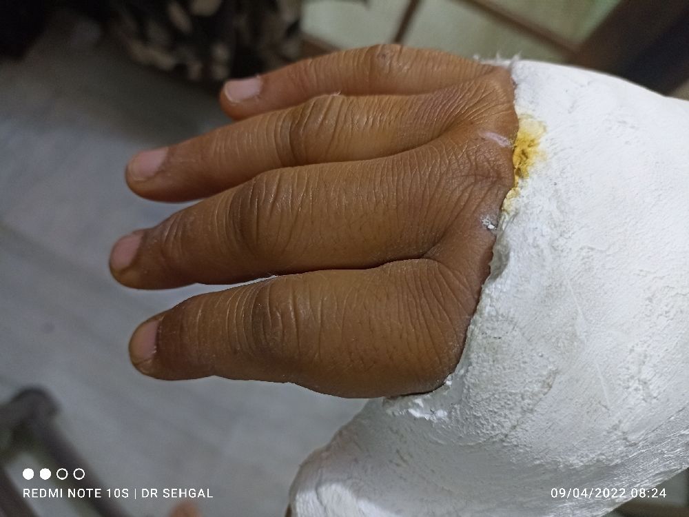 Pls Rx for K wire procedure in right hand's thumb metacarpal