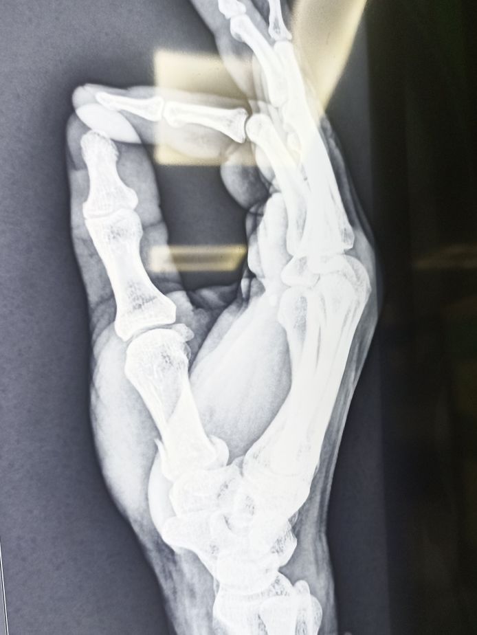 Pls Rx for K wire procedure in right hand's thumb metacarpal