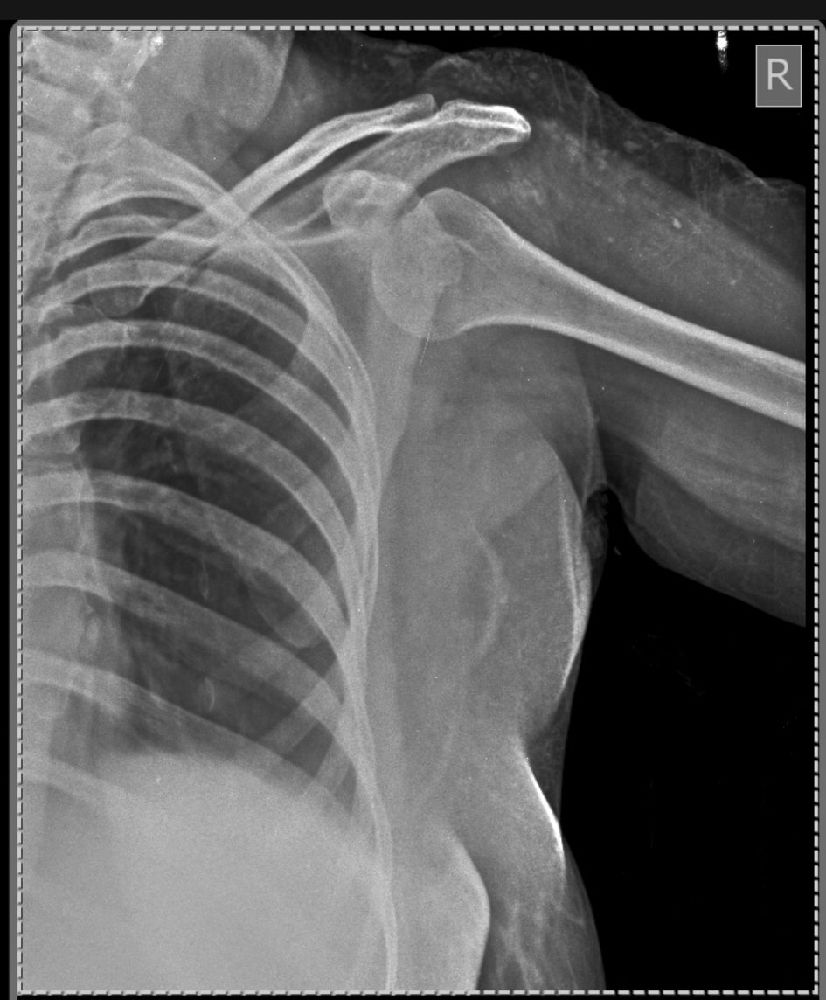 Interpretation of xray shoulder joint