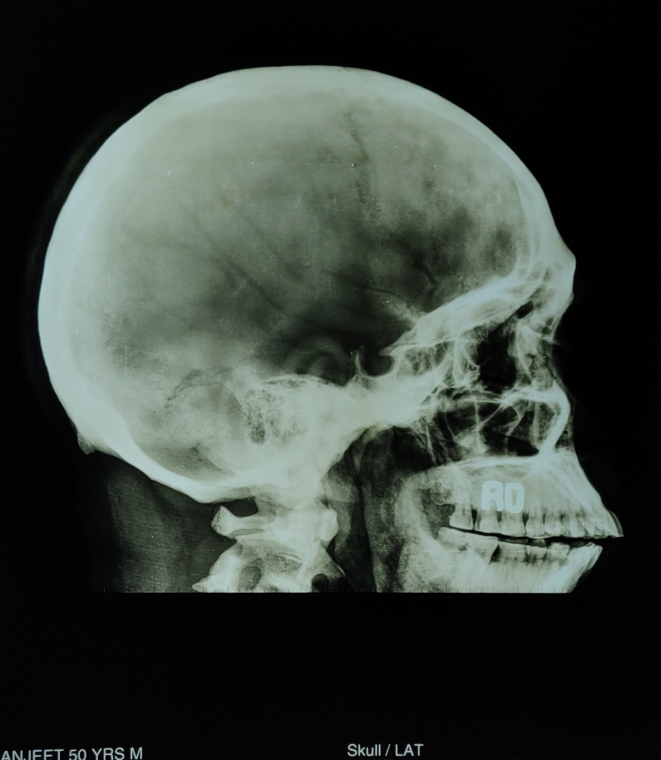 OSTEOPETROSIS or MARBLE BONE DISEASE
