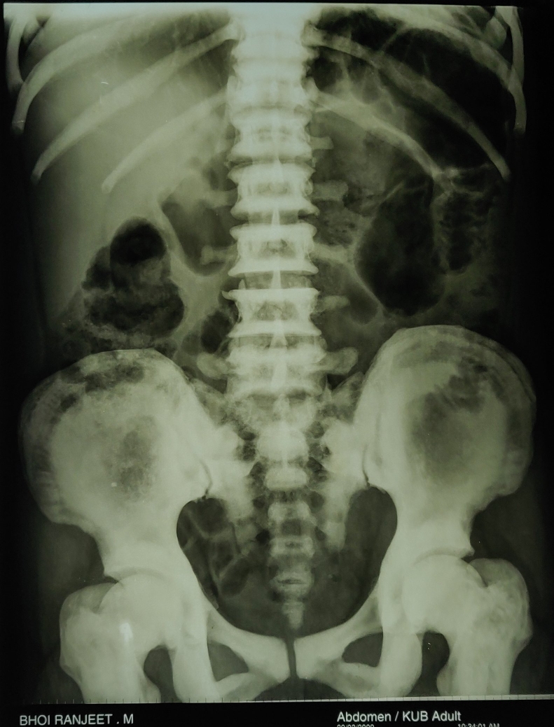 OSTEOPETROSIS or MARBLE BONE DISEASE