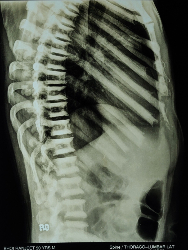 OSTEOPETROSIS or MARBLE BONE DISEASE