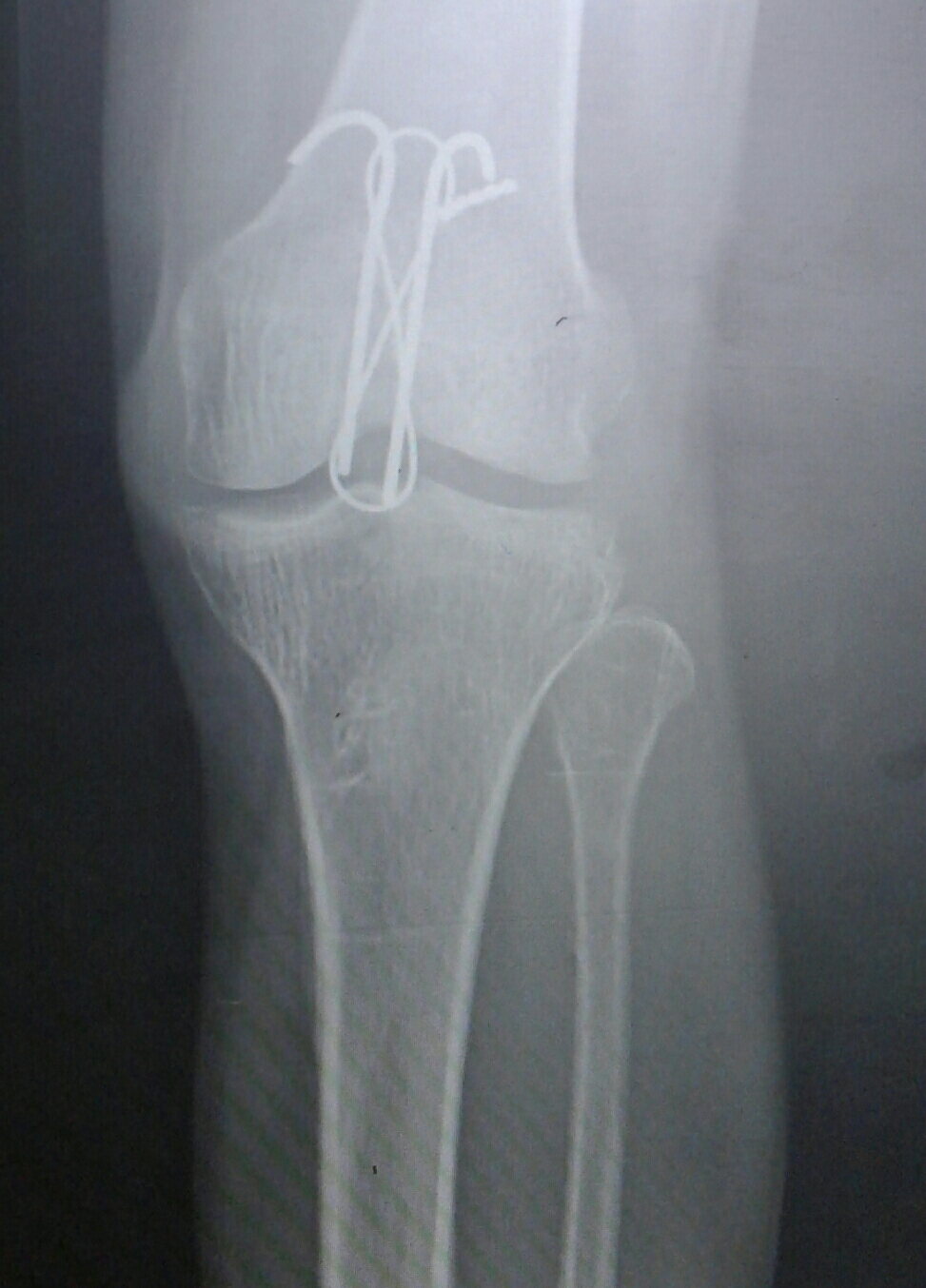 Inferior pole patella fixation