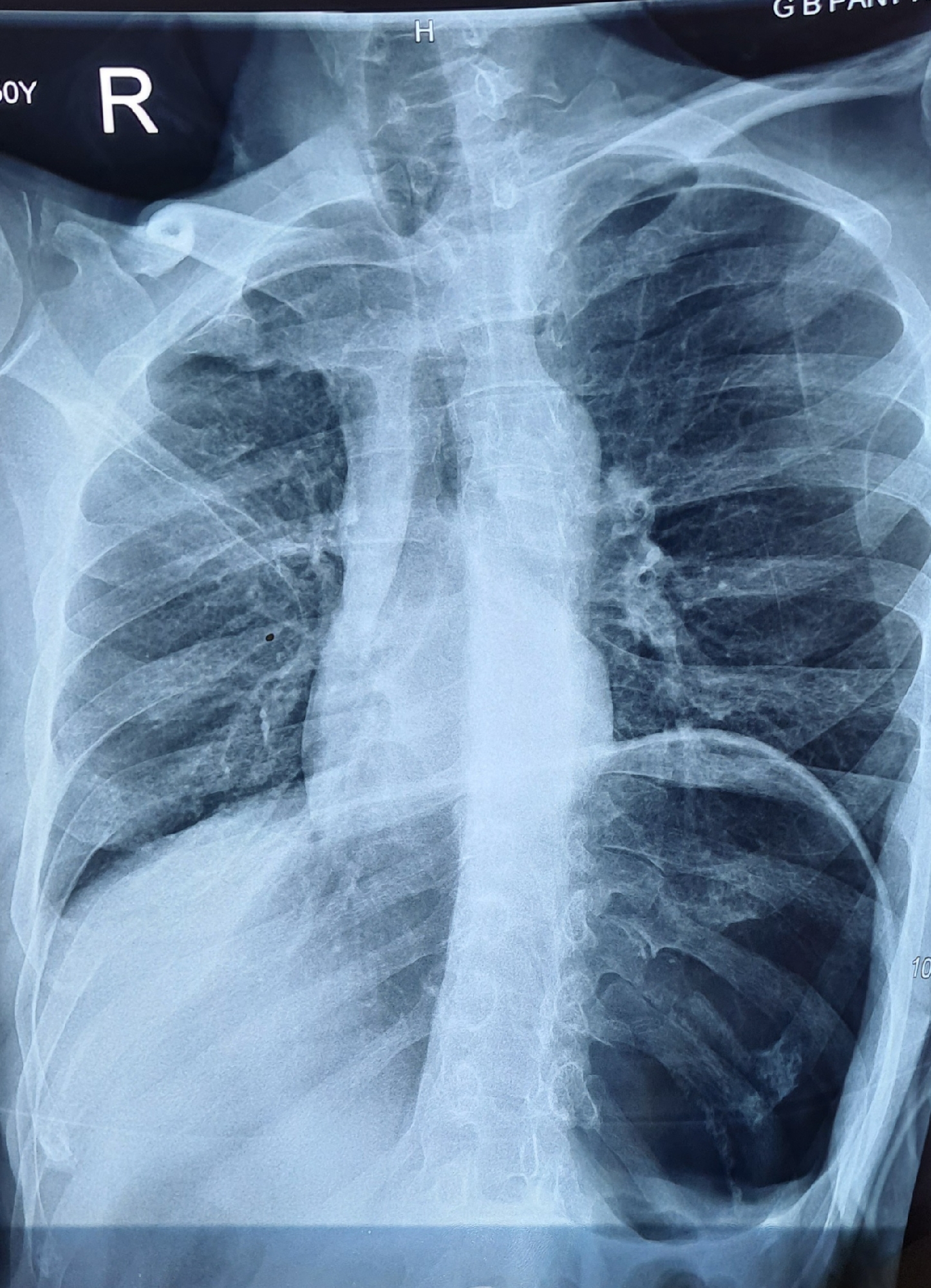 ?Lung collapse
