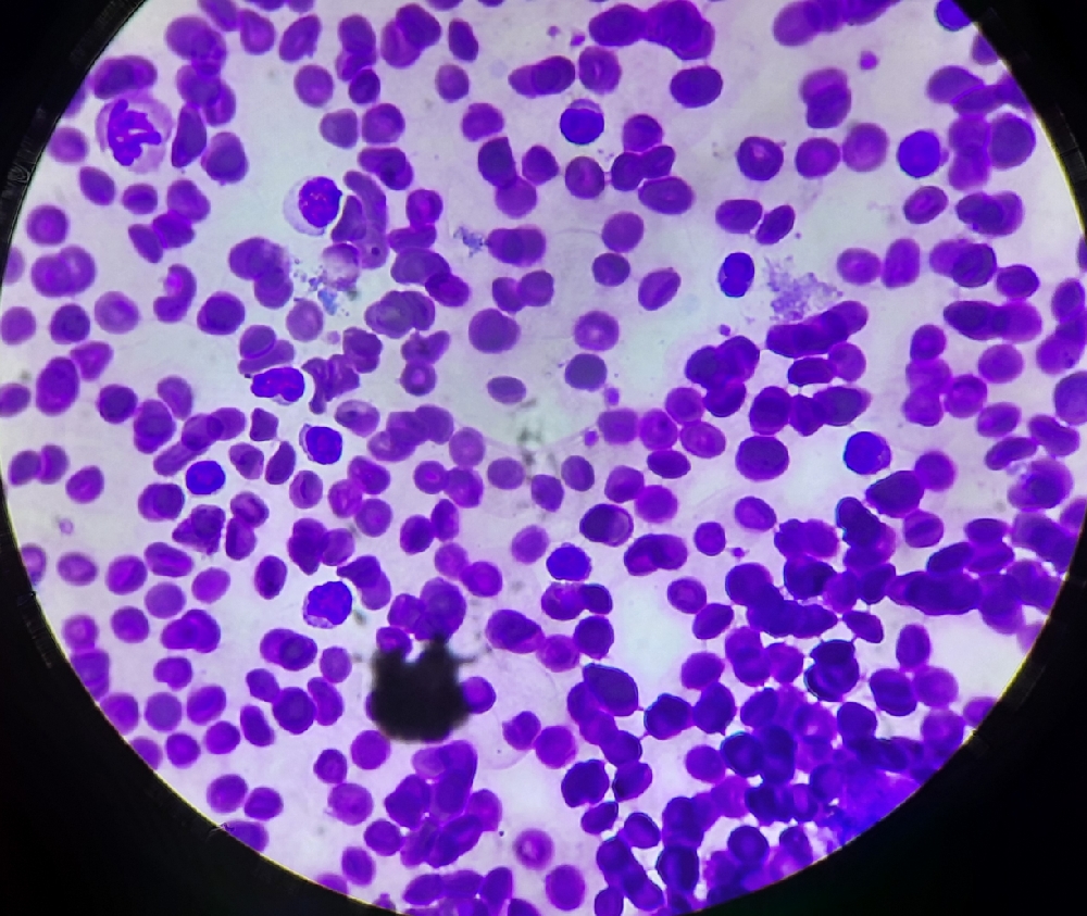 PERIPHERAL SMEAR EXAMINATION
