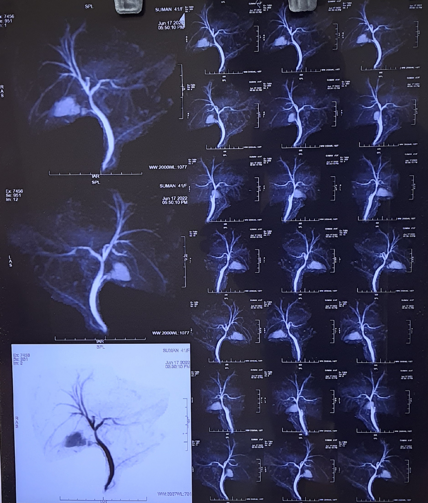 Cystic duct stump leak