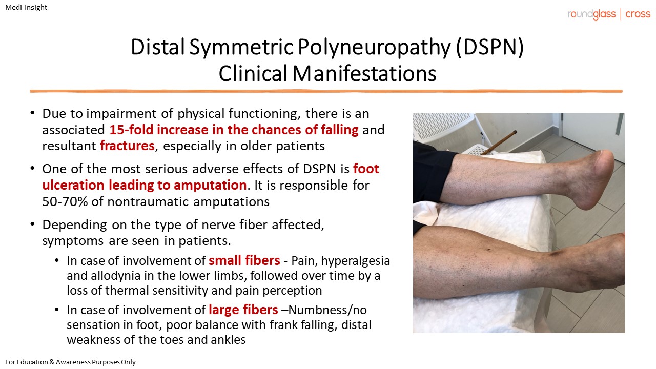 Diabetic Neuropathy DSPN