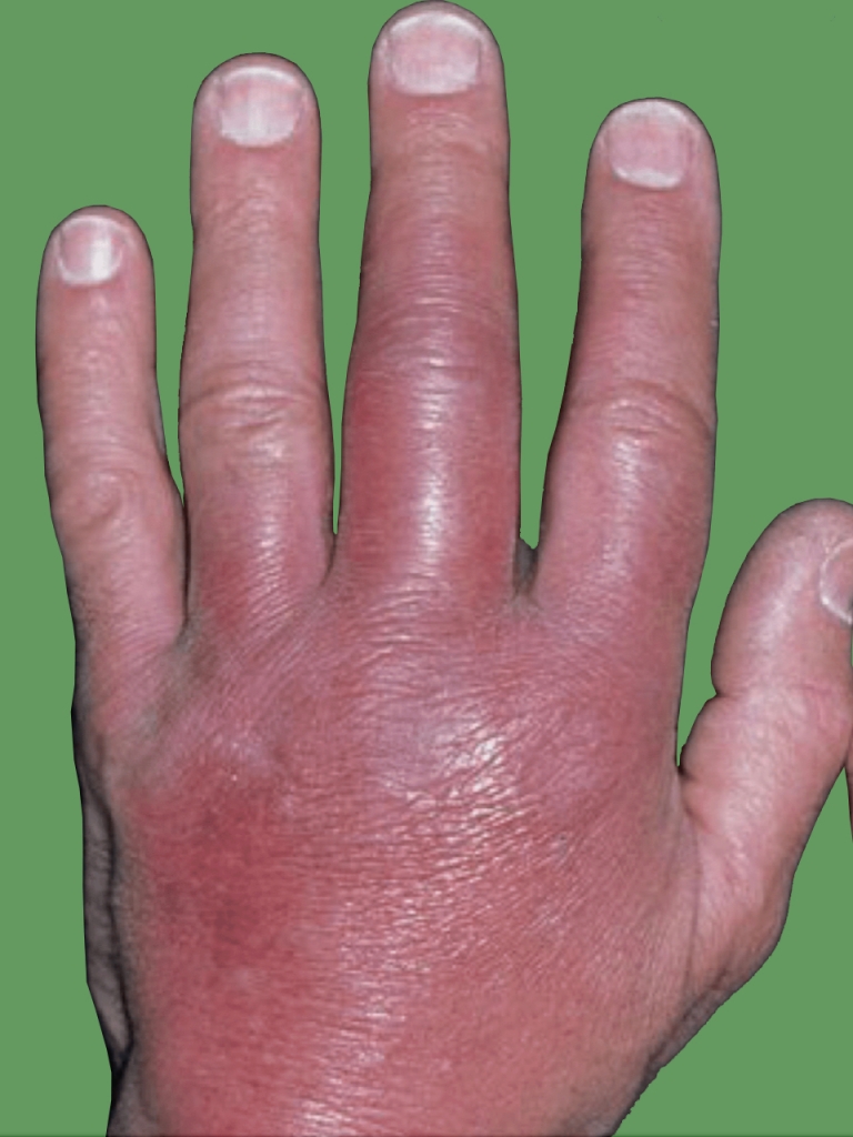 Cellulitis